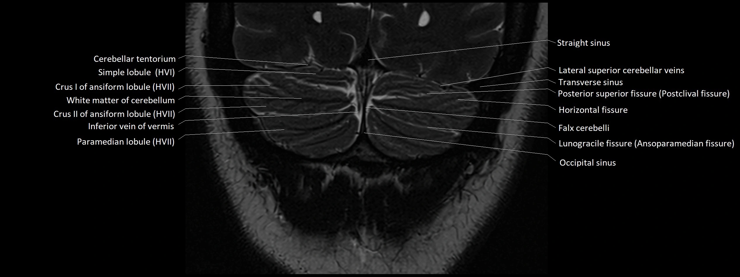 Anatomy of cerebellum coronal cross sectional 3T image 27.webp